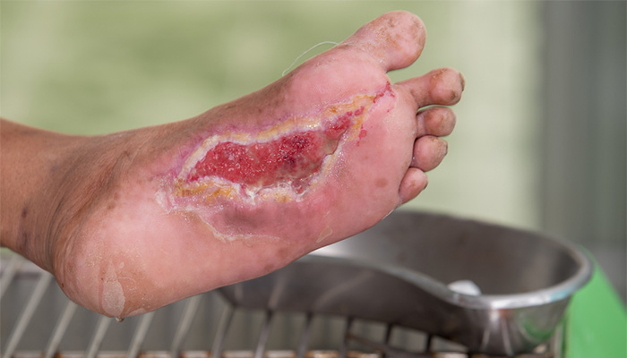 Tại sao bệnh nhân tiểu đường dễ bị nhiễm trùng? Do đường huyết cao, suy giảm hệ miễn dịch và biến chứng thần kinh