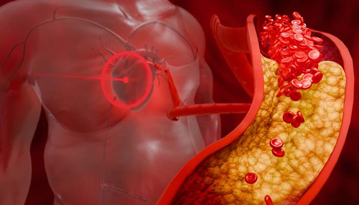 Bệnh tiểu đường gây tổn thương mạch máu do mức đường huyết quá cao 