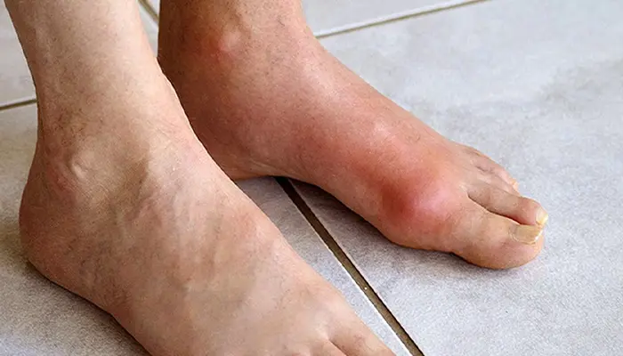 Bàn chân Charcot là một biến chứng nguy hiểm của bệnh lý thần kinh ở người tiểu đường