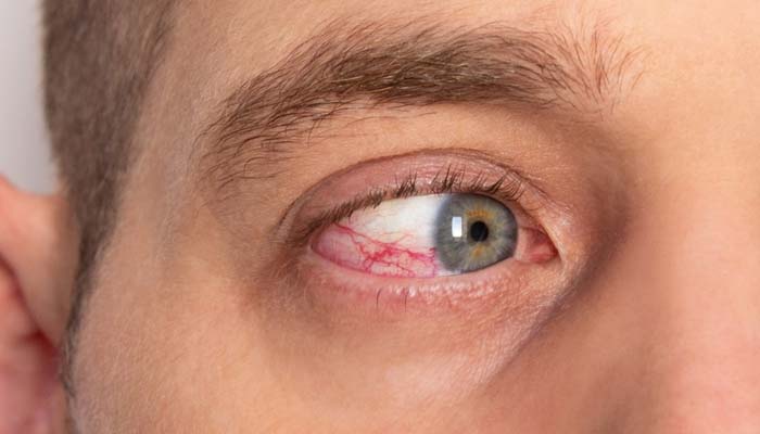 Biến chứng mạch máu nhỏ là một trong những dạng tổn thương mạch máu do tiểu đường gây ra 