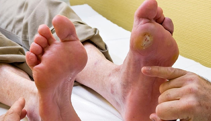 Biến chứng loét bàn chân ở người bệnh tiểu đường