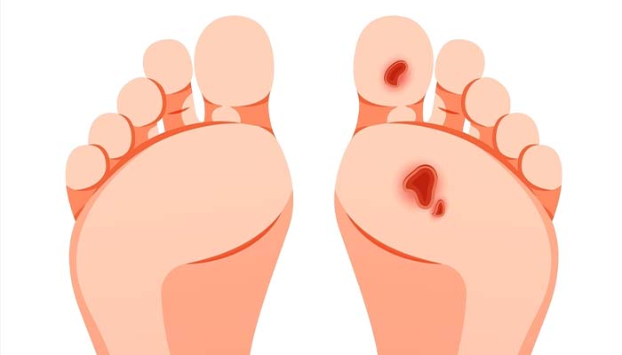 Tiền đái tháo đường khi tiến triển thành tiểu đường sẽ gây ra biến chứng ở chân