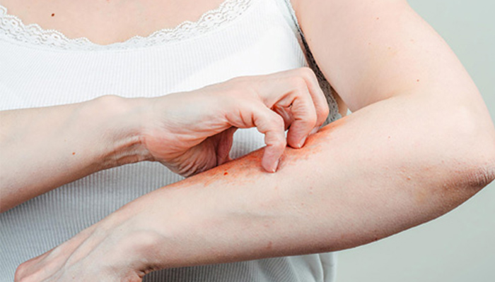 Bệnh tiểu đường gây ra biến chứng tổn thương trên da