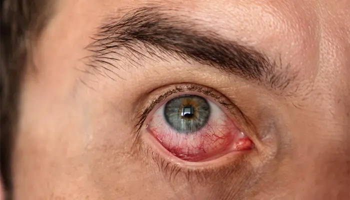 Tiểu đường có thể gây ra bệnh võng mạc