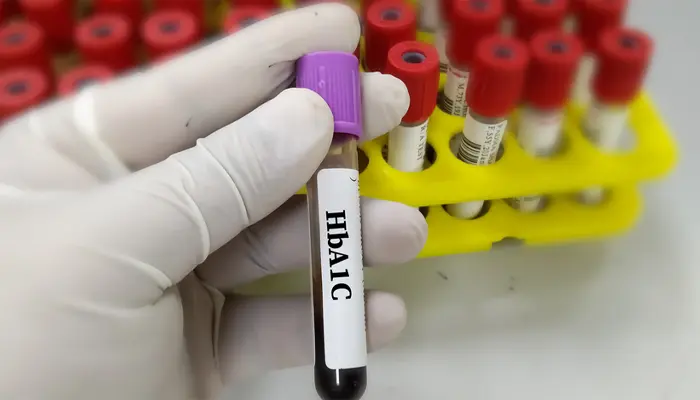 Để xác định mức giá xét nghiệm HbA1c còn phụ thuộc vào nhiều yếu tố