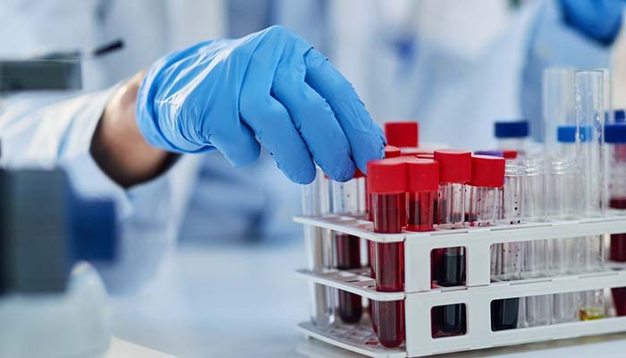 Chẩn đoán tiền đái tháo đường được thực hiện thông qua các xét nghiệm đường huyết