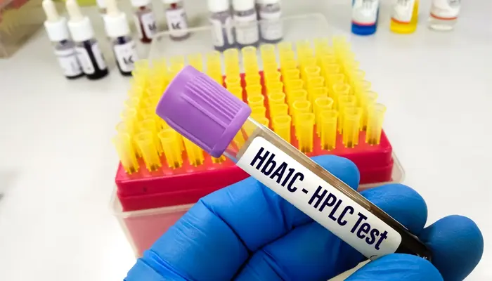 Chẩn đoán kháng insulin thông qua các xét nghiệm