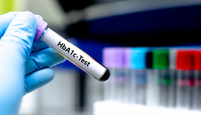 Chẩn đoán tiền đái tháo đường với xét nghiệm HbA1c