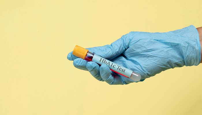 Xét nghiệm HbA1c chẩn đoán bệnh tiền đái tháo đường