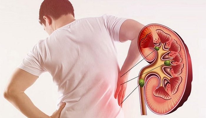 Đái tháo đường là nguyên nhân gây ra biến chứng suy thận mạn