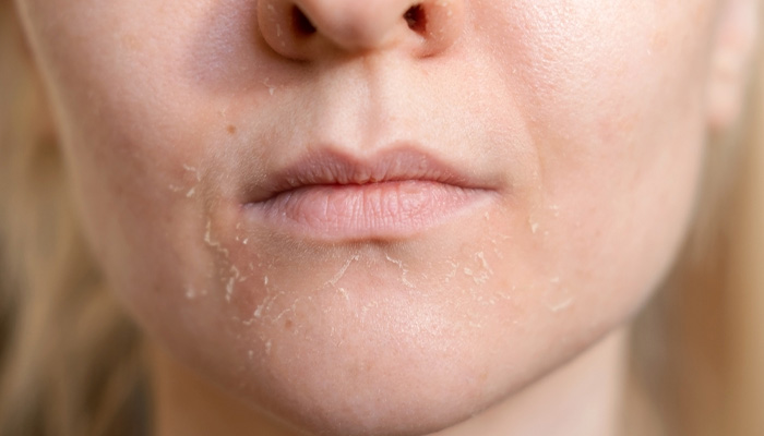 Người bị tiểu đường bị ngứa do da khô