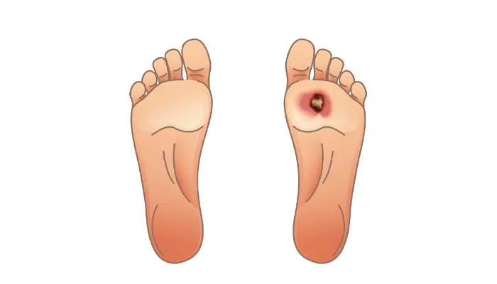 Dấu hiệu nhận biết hoại tử bàn chân vết thương đỏ sưng to