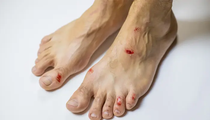 Vết thương lâu lành cũng là triệu chứng tăng đường huyết