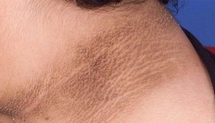 Dạ bị sậm màu ở cổ