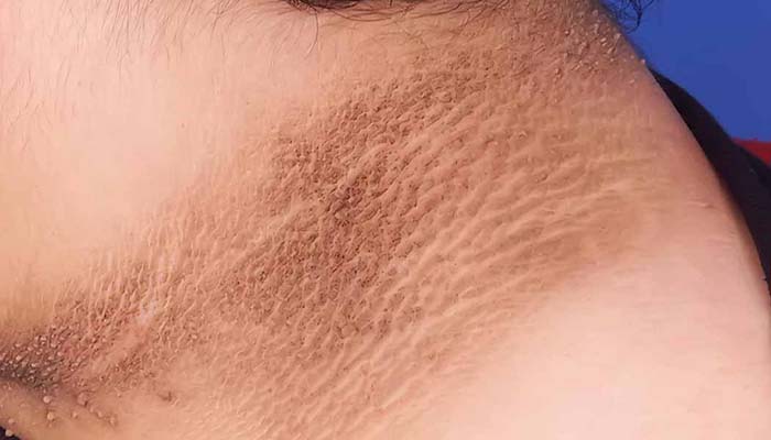 Dấu hiệu tiểu đường trên da bị gai đen