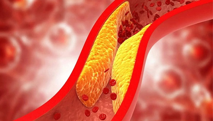 Đái tháo đường đi kèm cholesterol cao sẽ gây xơ vữa động mạch 