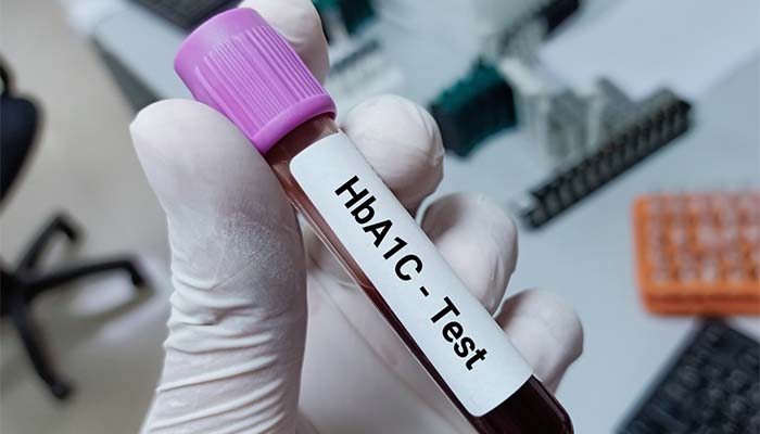 HbA1c tiền tiểu đường là xét nghiệm đường huyết 