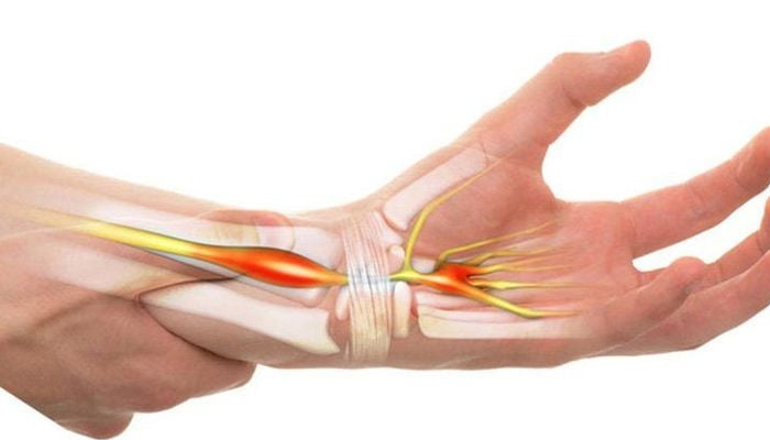 Hội chứng ống cổ tay