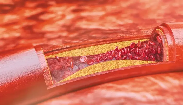 Kháng insulin và béo phì có mối quan hệ mật thiết với nhau