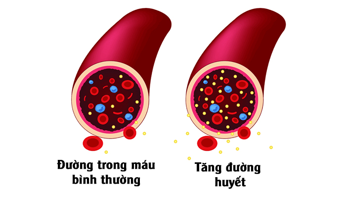 Tăng đường huyết cũng là nguyên nhân gây đau đầu