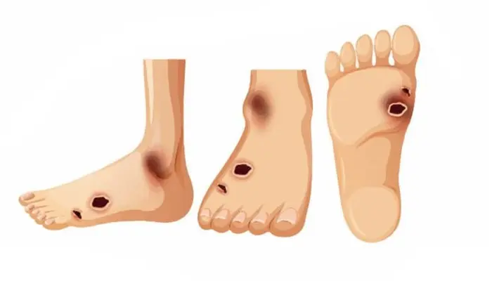 Nguyên nhân nhiễm trùng bàn chân tiểu đường có thể là do nhiễm khuẩn từ các vết loét