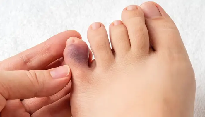 Nhiễm trùng bàn chân tiểu đường là biến chứng tiểu đường gây tổn thương ở bàn chân