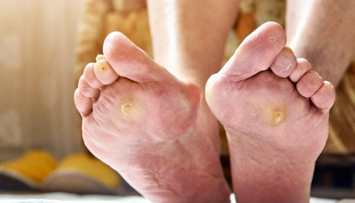 Nhiễm trùng bàn chân