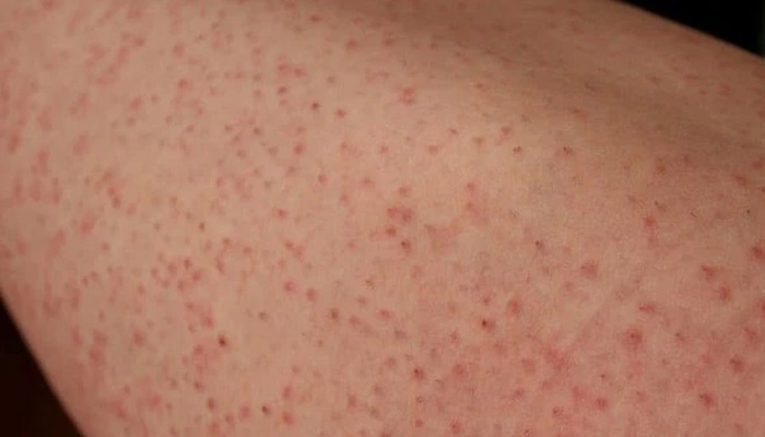 Da dễ bị nhiễm trùng