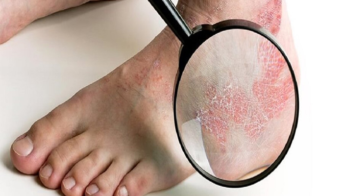 Bệnh tiểu đường và biến chứng nhiễm trùng có mối quan hệ mật thiết