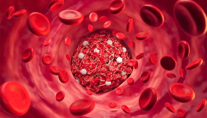 Tăng đường huyết là nồng độ glucose trong máu cao hơn mức bình thường