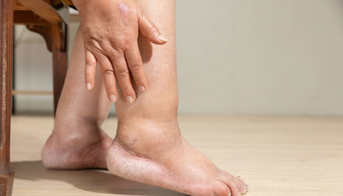 Người bệnh tiểu đường bị phù chân là hiện tượng tích tụ dịch bất thường ở chân