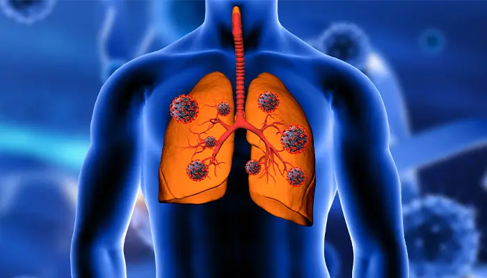 Tiểu đường biến chứng qua phổi do tổn thương hệ mạch máu tại phổi