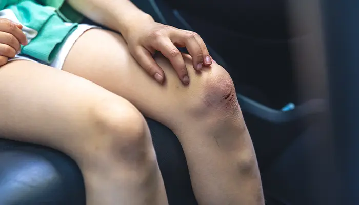 Người tiểu đường cần chăm sóc vết thương đúng cách để hạn chế nguy cơ nhiễm trùng, viêm loét cao 