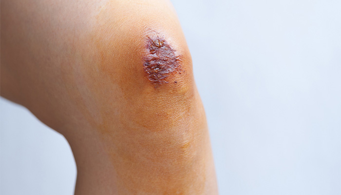 Tại sao bệnh tiểu đường vết thương lâu lành? Do lưu thông máu kém