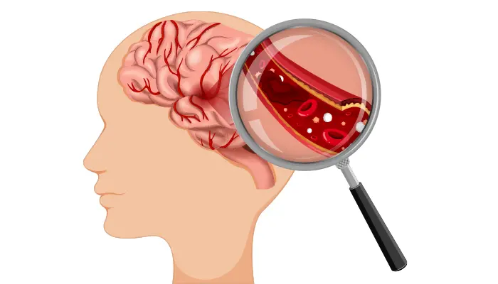 Tai biến mạch máu não là tình trạng lưu lượng máu lên não bị gián đoạn