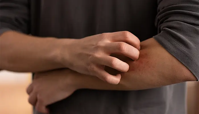 Ngứa da là tình trạng khá phổ biến ở người bệnh tiểu đường 