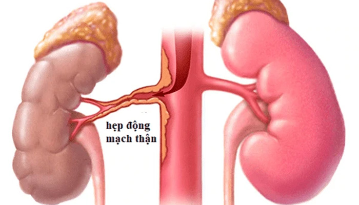 Đái tháo đường làm hẹp lòng mạch thận