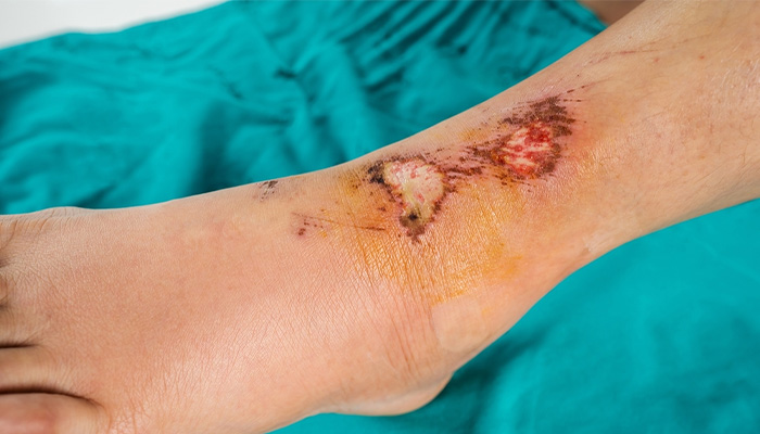 Da bị tổn thương mô