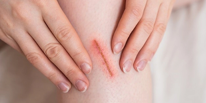 Vết thương lâu lành do bệnh đái tháo đường
