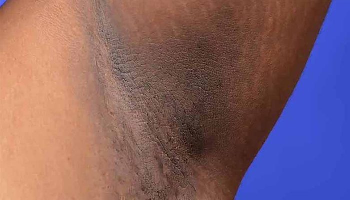 Da sẫm màu ở vùng nách