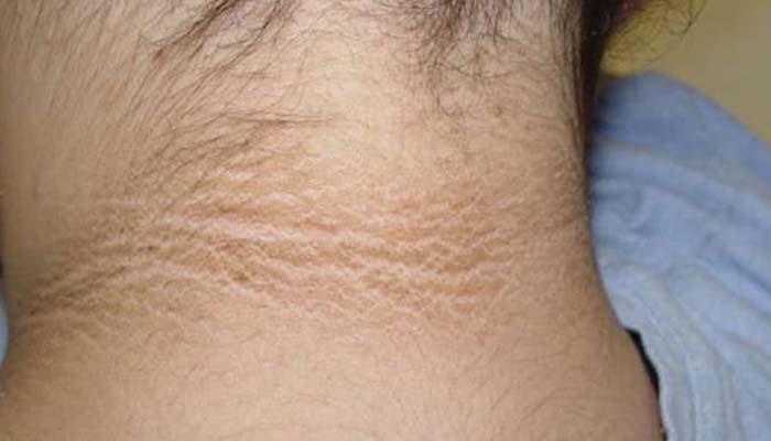 Dấu hiệu da bị gai đen ở vùng gáy