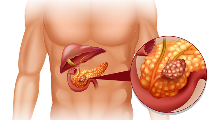 Tuyến tụy và bệnh tiểu đường có mối quan hệ mật thiết