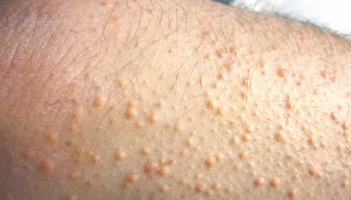 Biến chứng u vàng phát ban