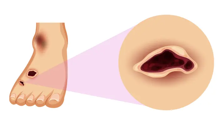 Vết loét lâu ngày có thể dẫn đến hoại tử phải cắt cụt chi