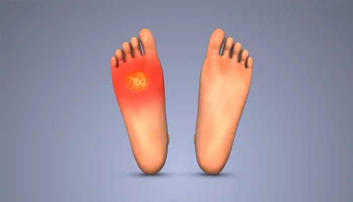 Vết loét tiểu đường ở chân là tình trạng tổn thương da sâu, khó lành