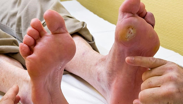 Đường huyết tăng cao gây ra biến chứng loét chân