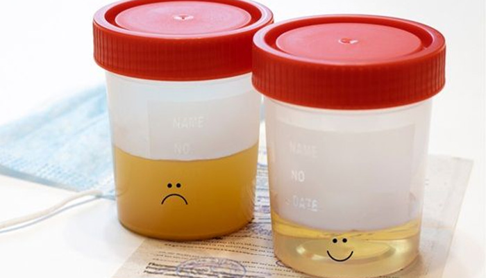 Do đường trong máu tăng cao nên nước tiểu sẽ thay đổi