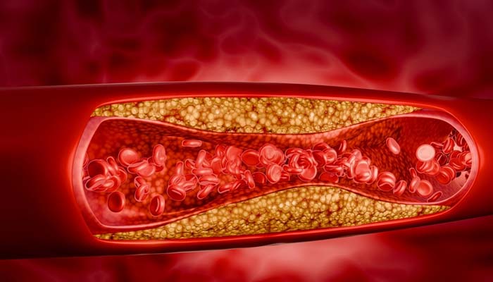 Tình trạng kháng insulin cũng là nguyên nhân gây tăng đường huyết khi đói