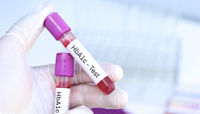 Xét nghiệm chẩn đoán tiểu đường tuýp 1 HbA1c
