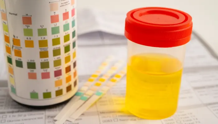 Thực hiện xét nghiệm glucose trong nước tiểu để đánh giá